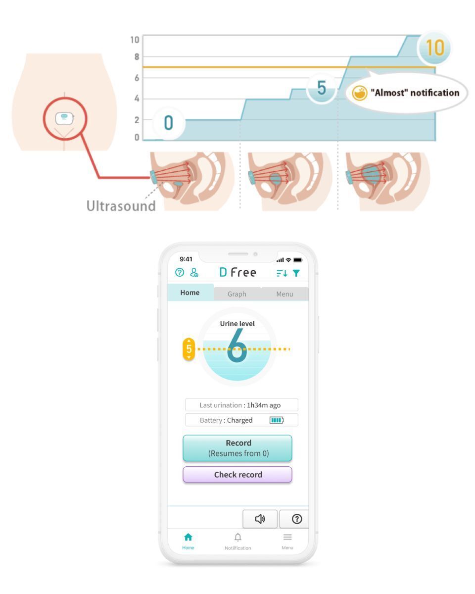 An image showing how the DFree device uses ultrasonic sensors to monitor the bladder, and an example of a smartphone notification